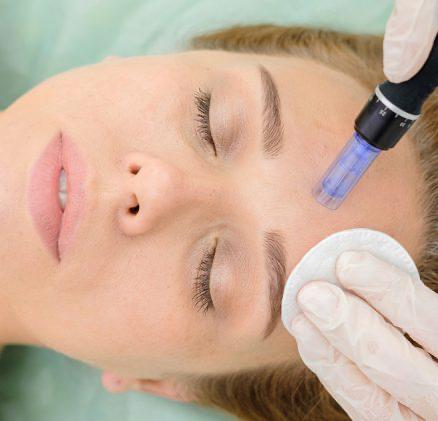 MicroNeedling Collagen Treatments